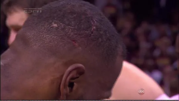 Blessure à la tête de LeBron James