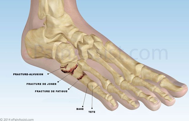 Fracture de Jones